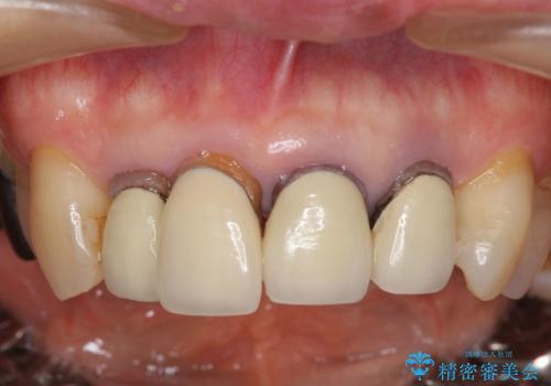 老朽化した前歯のセラミック治療やりかえの症例 治療前