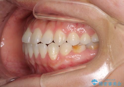 隙間の空いた前歯を治したい　インビザライン矯正治療の治療前