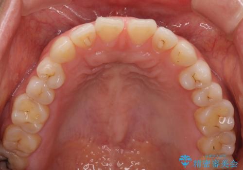隙間の空いた前歯を治したい インビザライン矯正治療の治療前
