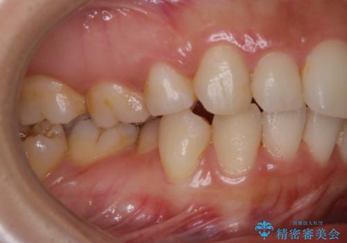 久々の来院で歯のクリーニング PMTC60分コースの治療前