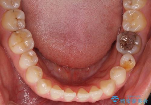 隙間の空いた前歯を治したい インビザライン矯正治療の治療前