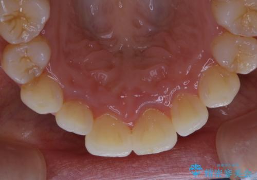 久々の来院で歯のクリーニング PMTC60分コースの治療前