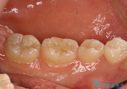 半年ぶりのPMTCの治療前