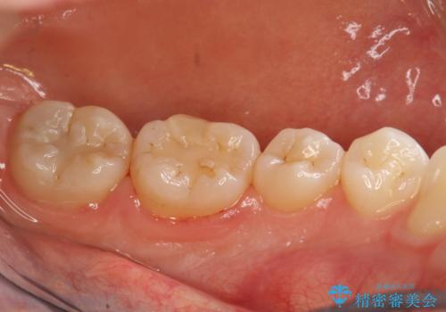 半年ぶりのPMTCの治療後