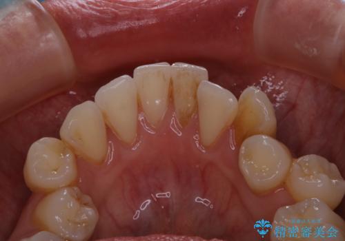 久々の来院で歯のクリーニング PMTC60分コースの治療前