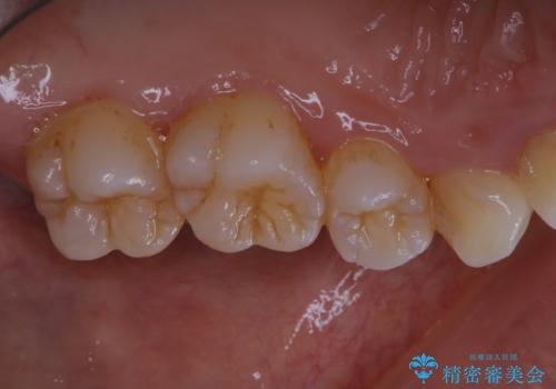 久々の来院で歯のクリーニング PMTC60分コースの治療前
