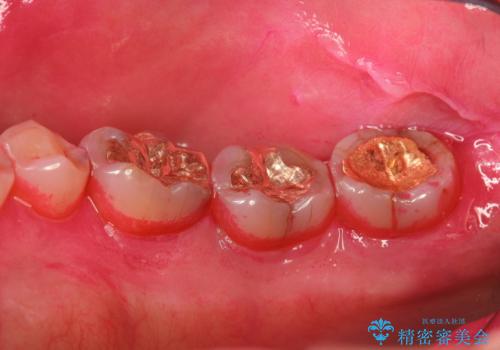 奥歯の汚れもPMTCでしっかり除去
