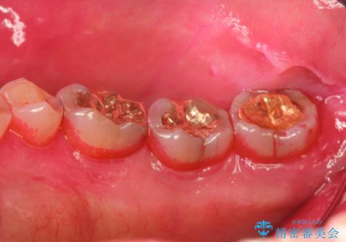 奥歯の汚れもPMTCでしっかり除去の治療前
