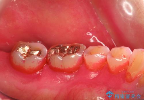 奥歯の汚れもPMTCでしっかり除去の治療前