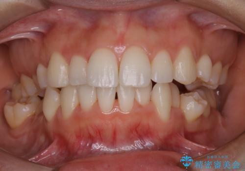 久々の来院で歯のクリーニング PMTC60分コースの治療後