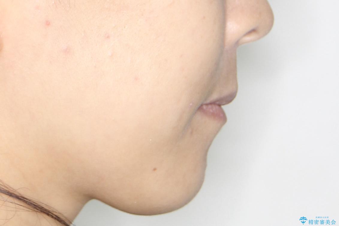 歯が前に出てて、口が閉じない 抜歯矯正による口元の改善の治療後(顔貌)