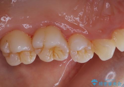 久々の来院で歯のクリーニング PMTC60分コースの治療後