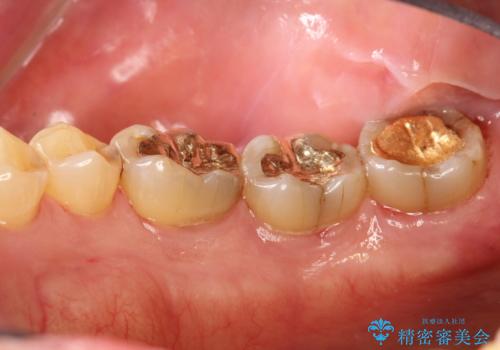 奥歯の汚れもPMTCでしっかり除去の治療後