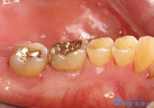 奥歯の汚れもPMTCでしっかり除去の治療後