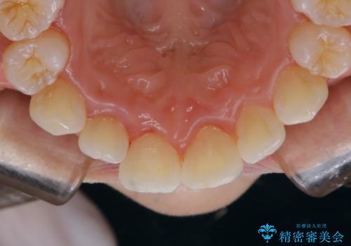 久々の来院で歯のクリーニング PMTC60分コースの治療後