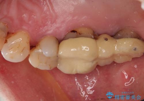 歯周病の進行した歯の抜歯。オールセラミッククラウンの症例 治療前