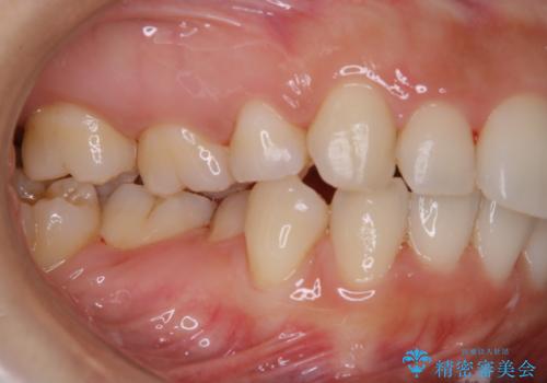 久々の来院で歯のクリーニング PMTC60分コースの治療後