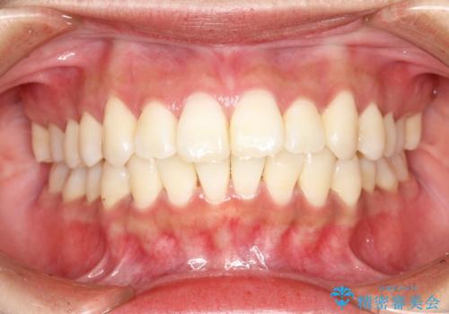 がたがたをインビザラインで整った歯並びへの症例 治療後