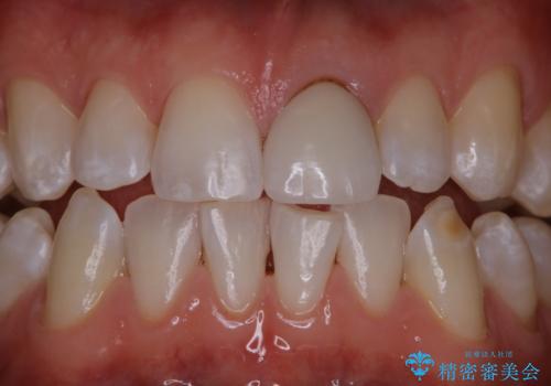着色・ステイン除去をPMTCでの症例 治療後