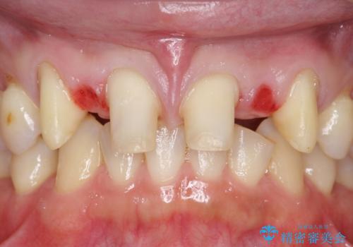 オールセラミッククラウン　部分矯正とセラミックによる前歯部の見た目の改善の治療中
