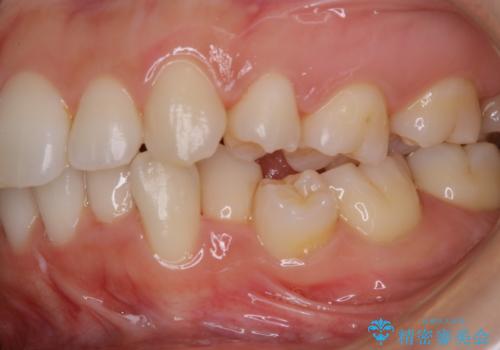 久々の来院で歯のクリーニング PMTC60分コースの治療後