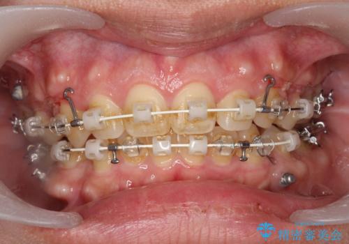 ワイヤー矯正中の歯のクリーニング　PMTCの治療前