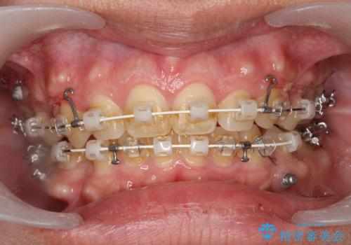ワイヤー矯正中の歯のクリーニング　PMTCの症例 治療前