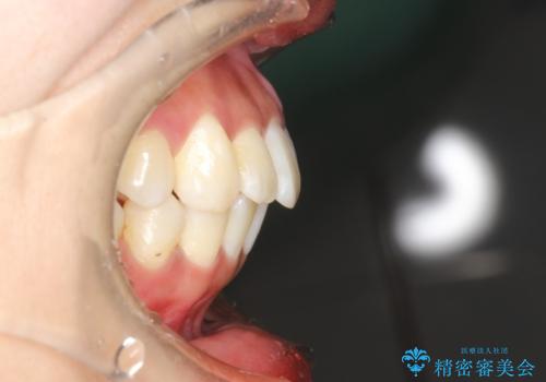 がたがたをインビザラインで整った歯並びへの治療後