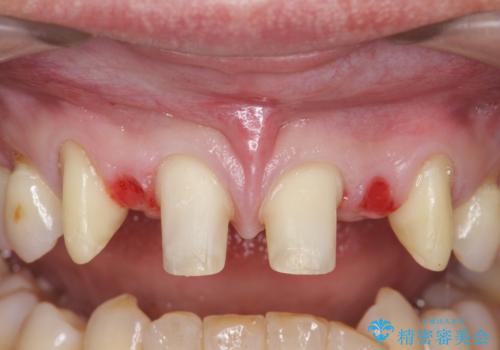オールセラミッククラウン 部分矯正とセラミックによる前歯部の見た目の改善の治療中