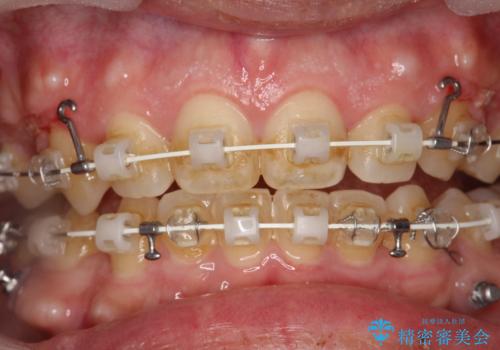 ワイヤー矯正中の歯のクリーニング　PMTCの治療前