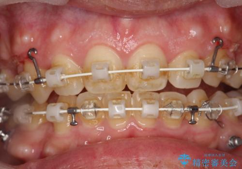 ワイヤー矯正中の歯のクリーニング　PMTC