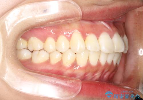 がたがたをインビザラインで整った歯並びへの治療後