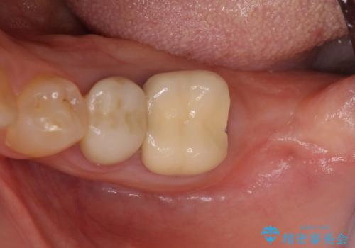 痛みを感じる奥歯　根管治療とインプラント治療の症例 治療前