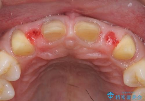 オールセラミッククラウン 部分矯正とセラミックによる前歯部の見た目の改善の治療中