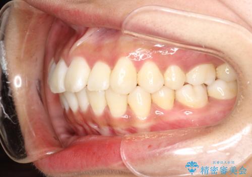 がたがたをインビザラインで整った歯並びへの治療後
