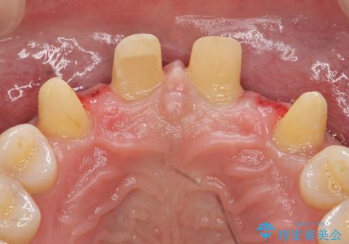 オールセラミッククラウン 部分矯正とセラミックによる前歯部の見た目の改善の治療中