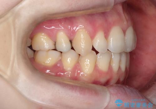 ワイヤーによる出っ歯の矯正　前歯でかめるようにの症例 治療後