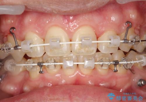 ワイヤー矯正中の歯のクリーニング PMTCの治療後