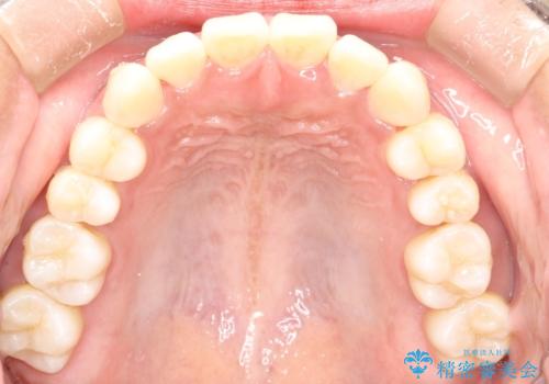 がたがたをインビザラインで整った歯並びへの治療後