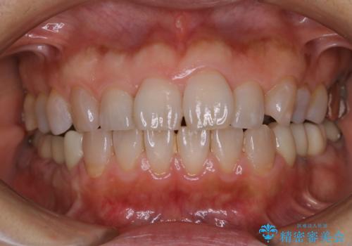 口臭予防のため歯科医院での歯の掃除 PMTCの治療前