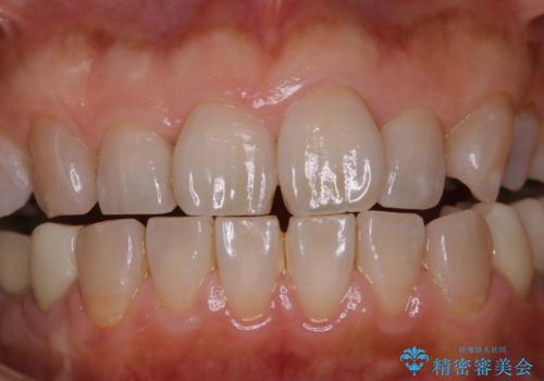 口臭予防のため歯科医院での歯の掃除　PMTCの治療前