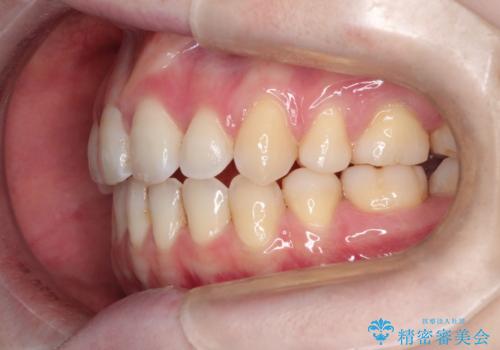ワイヤーによる出っ歯の矯正　前歯でかめるようにの治療後