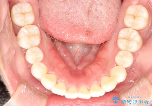 がたがたをインビザラインで整った歯並びへの治療後
