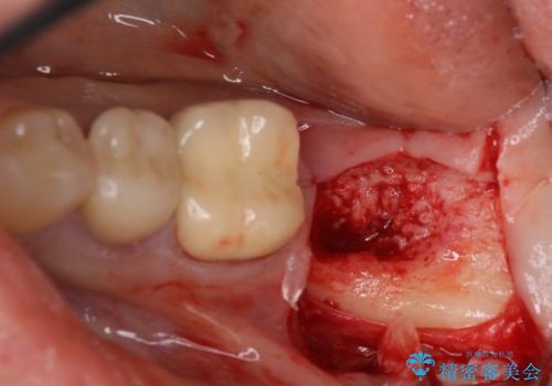 痛みを感じる奥歯　根管治療とインプラント治療の治療中