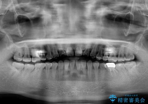 隙間の空いた前歯を治したい インビザライン矯正治療の治療前