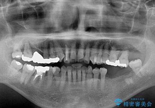 歯周病改善のための総合歯科治療の治療前
