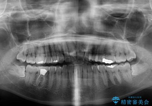 気になる上の歯を改善 インビザライン矯正の治療前