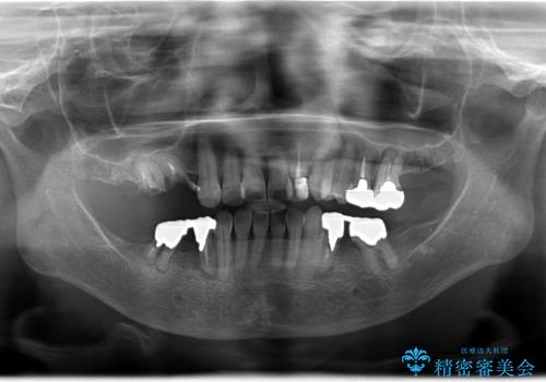奥歯がなくなり咬めない インプラント治療による咬み合わせの回復の治療前