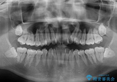 八重歯を治したい 目立たないワイヤー装置での抜歯矯正の治療前