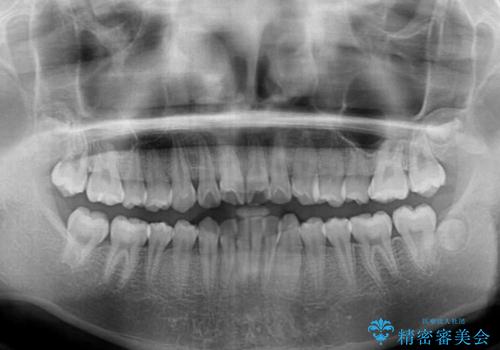 前歯のデコボコを短期間で治療 目立たないワイヤー矯正の治療前